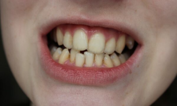 пример искривления зубов