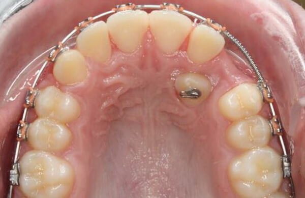 пример ретинированных зубов
