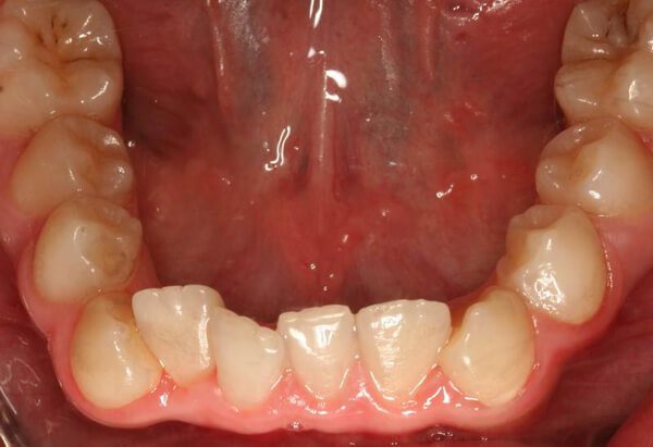 сужение зубного ряда